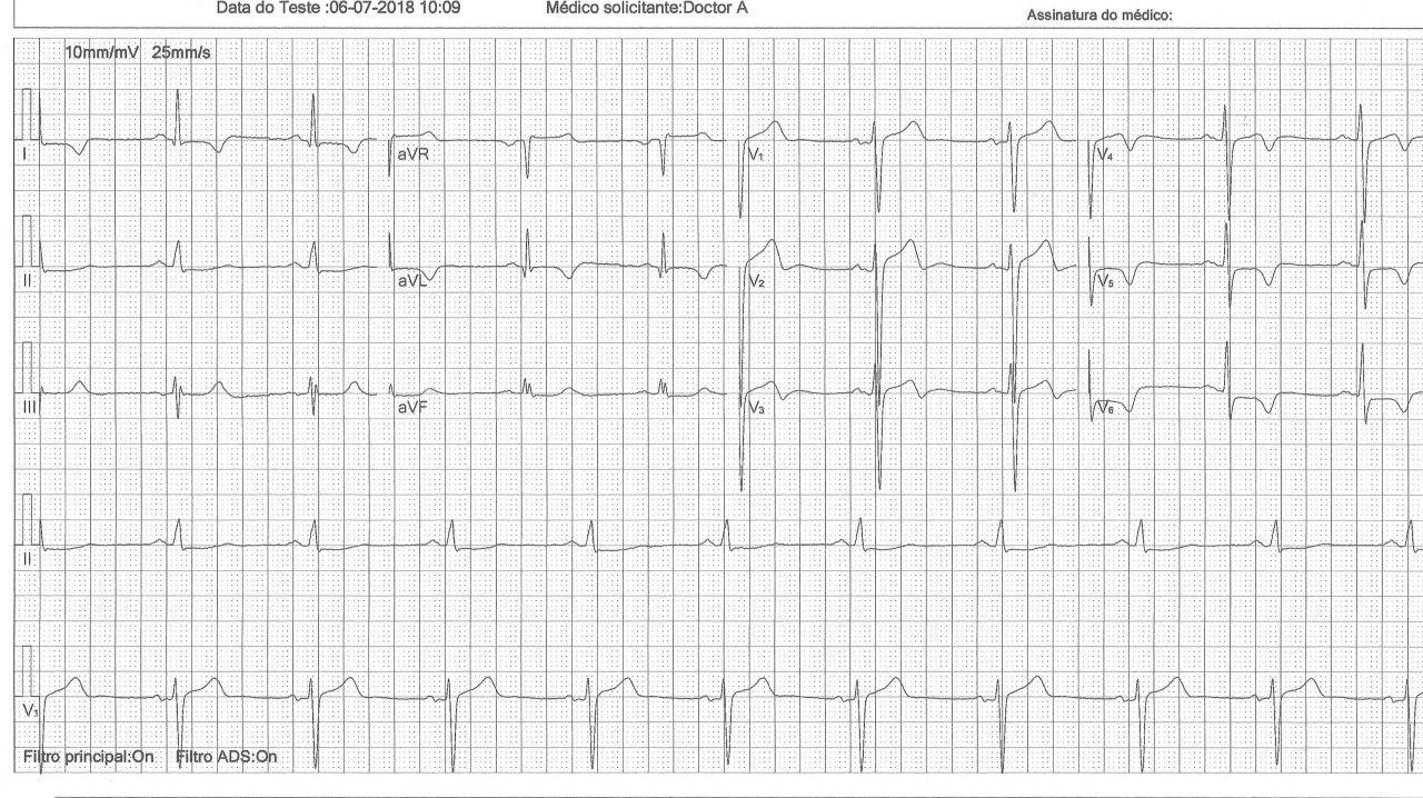 Paciente masculino de 47 años con disnea y mareos por presentar miocardiopatía hipertrófica asimétrica obstructiva