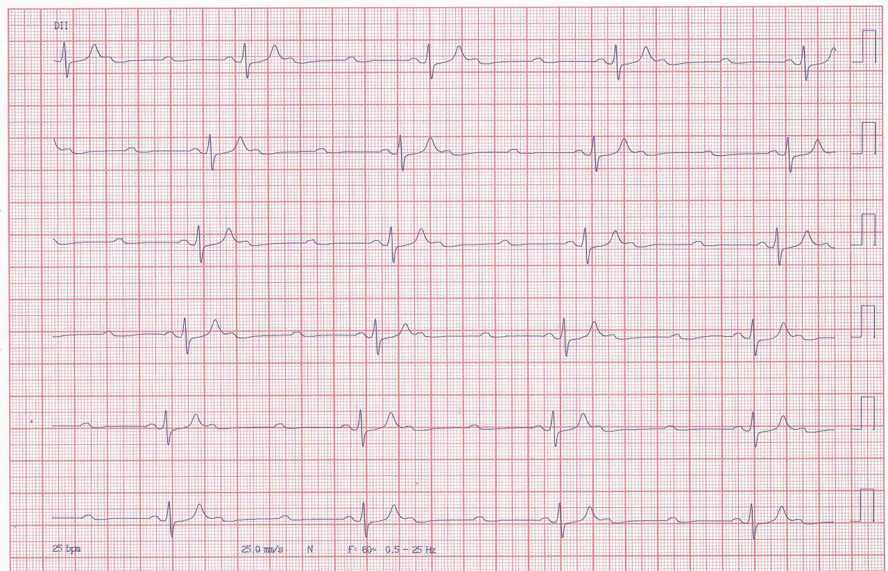 Paciente que presenta episodio sincopal por BAV de alto grado que no responde a la estimulación del MP por sobresensado de la onda T gigante por hiperkalemia
