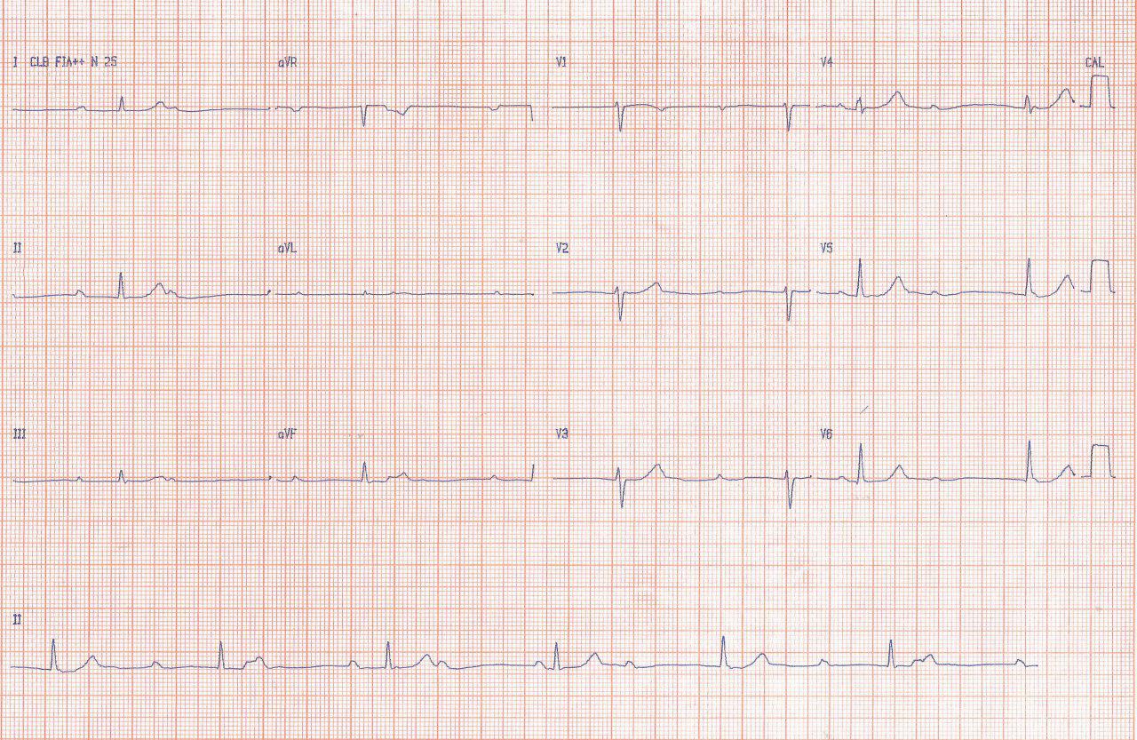 Mujer de 26 años con disnea progresiva que presenta BAVC congénito por lo que se indica MP bicameral con falla de detección auricular intermitente