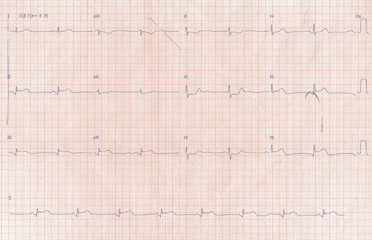 SCA por compromiso de la arteria Cx proximal