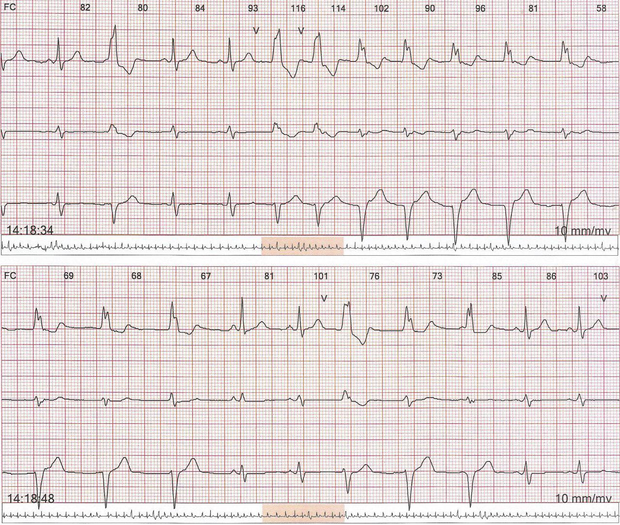 Mujer joven con palpitaciones ocasionales por presentar TV parasistólica