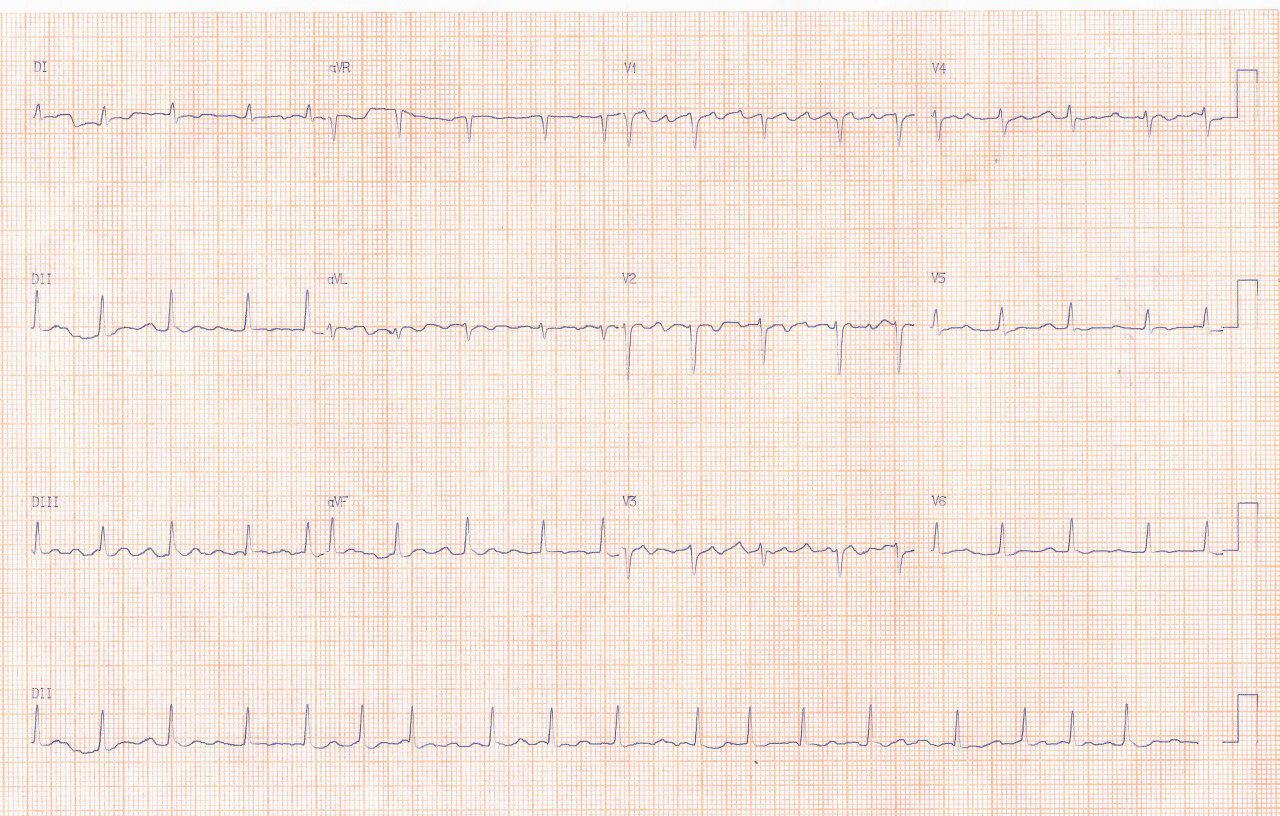 Mujer de 36 años en espera de cirugía de reemplazo valvular mitral que presenta intoxicación digitálica con mejoría luego de suspender la digital