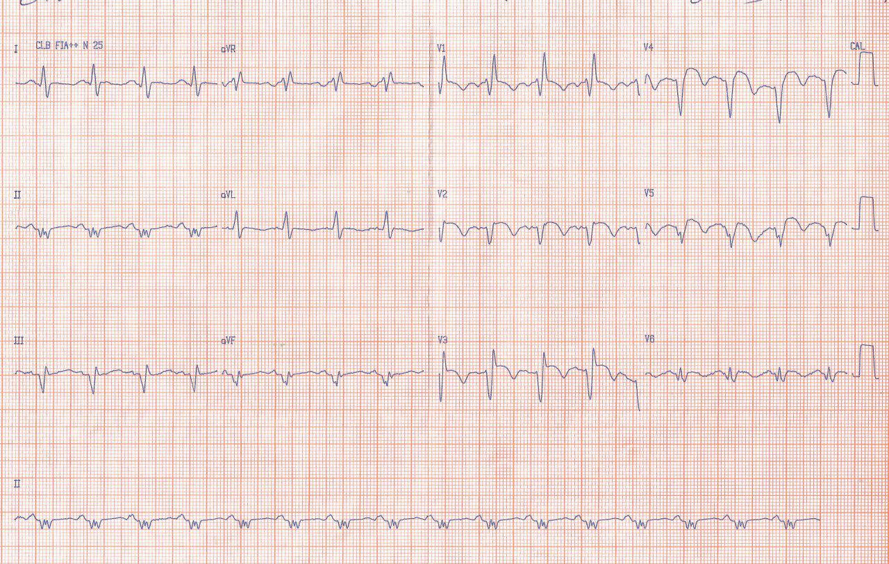 Paciente de 45 años que presenta EAP complicando infarto anterior en evolución e infarto previo inferior con aparición de RIVA por reperfusión incompleta luego del implante de dos stents en obstrucción completa de DA con trombo y 99% de CD