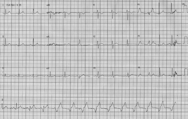 Mujer de 28 años que presenta palpitaciones luego de la muerte de su padre por presentar RIVA con imagen de BCRI