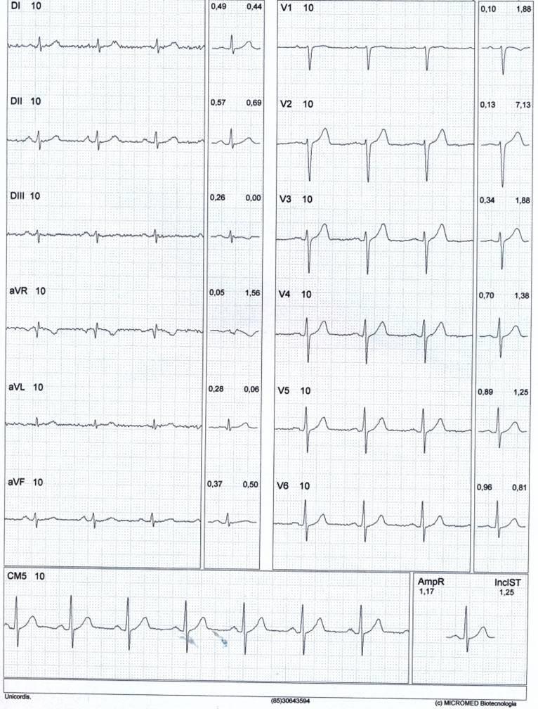 Paciente de 46 años, asintomatico con FR, que realiza PEG que resulta + por angor y ST por oclusión proximal de DA