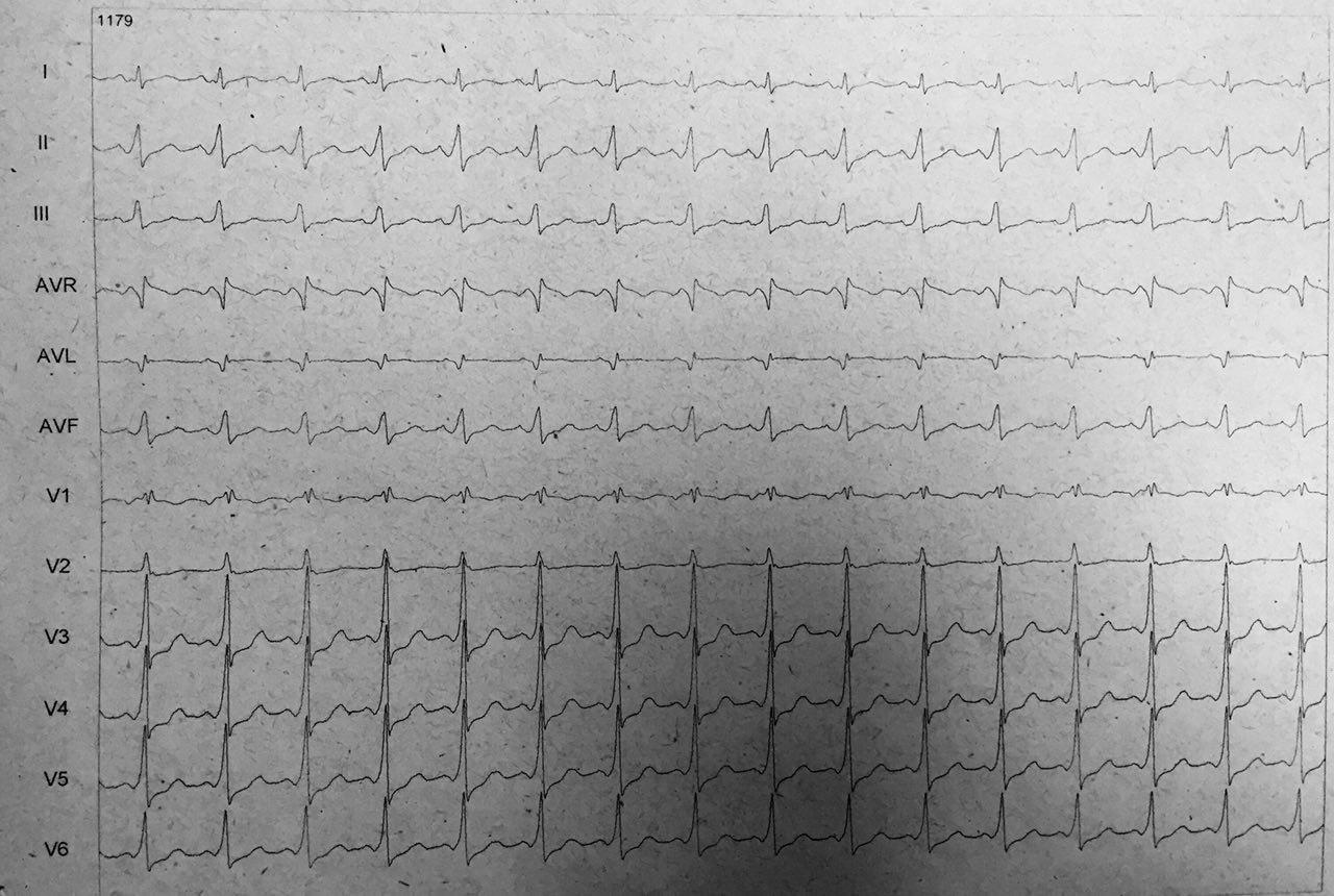 Paciente de 63 años que comienza con palpitaciones que se interpretan debidas a presencia de taquicardia ortodrómica y luego antdrómica con ablación exitosa