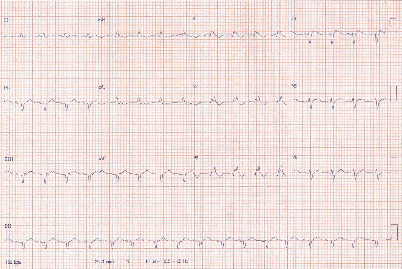 Paciente masculino de 60 años con factores de riesgo e historia familiar de MS que presenta angor prolongado por SCA debido a obstrucción total de la DA