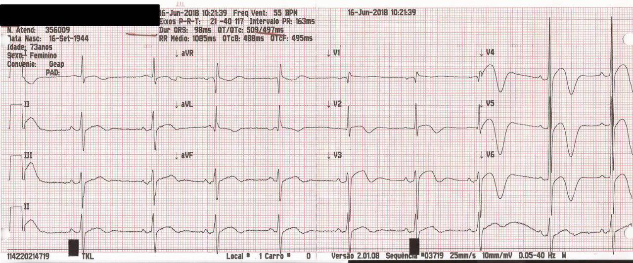 Mujer hipertensa de 75 años con cefalea y deterioro del nivel de consciencia por presentar hemorragia subaracnoidea