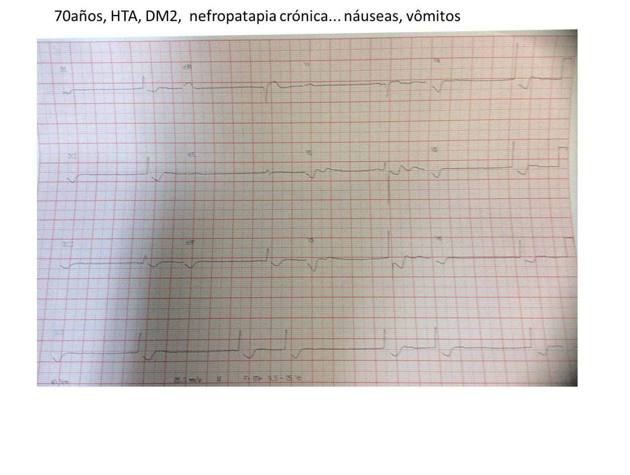 Paciente de 70 años HTA y DBT con nefropatía crónica, digitalizado por FA crónica que presenta intoxicación digitálica con ritmo de la unión AV con bloqueo de salida intermitente