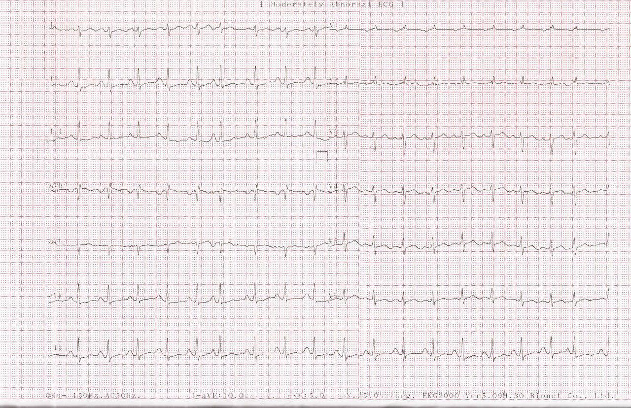 Paciente de 31 años con disnea y hemoptisis por estenosis mitral con área valvular de 0,7cm2 que es sometida a valvuloplastia exitosa