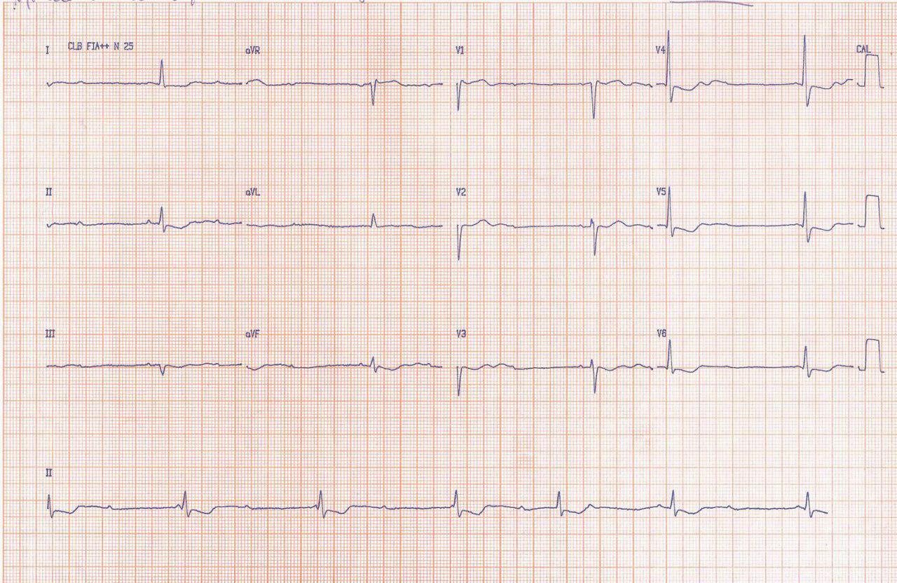 Mujer de 72 años con náuseas y vómitos por intoxicación digitálica que determina BAVC