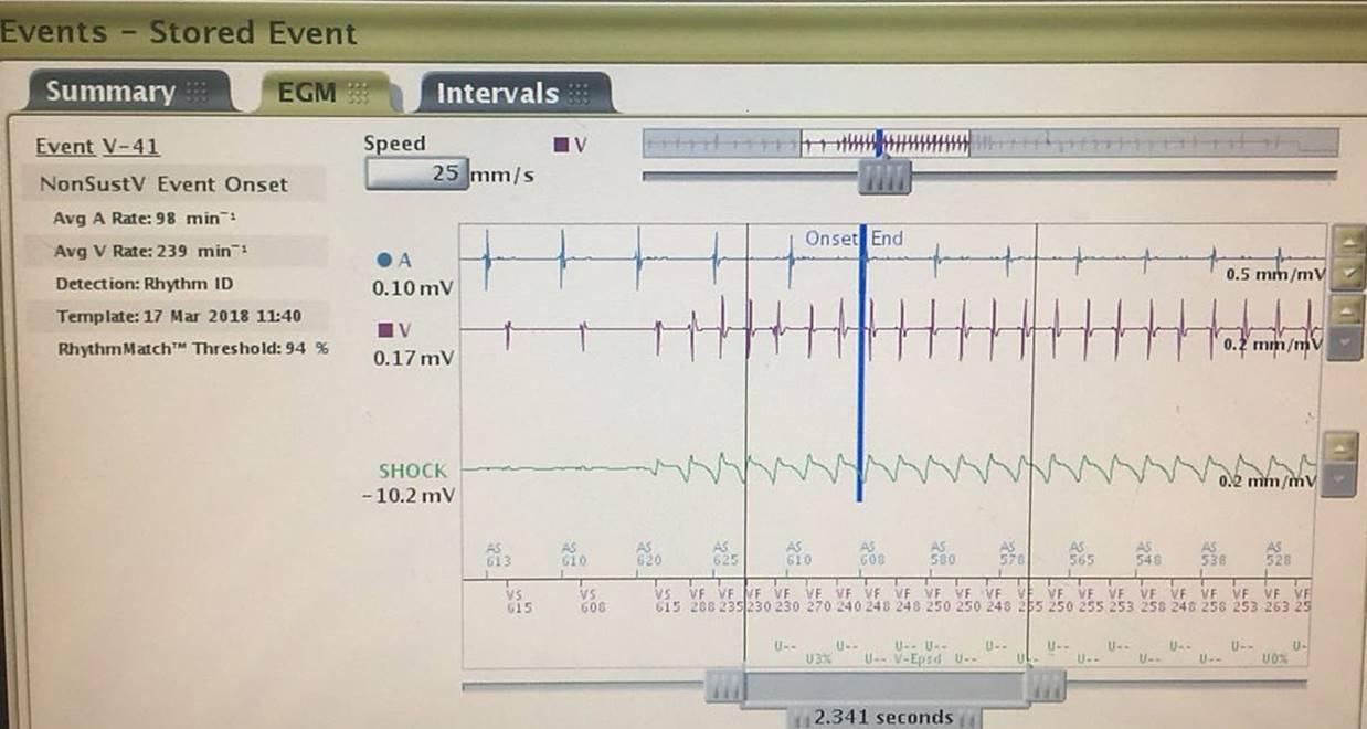 Electrogramas de CDI en un paciente portador de miocardiopatía arritmogénica de VI donde se observa presencia de disociación AV y luego episodio de TA