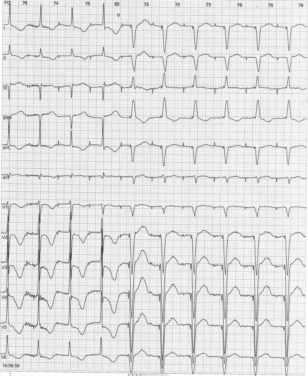 Paciente portador de MP y en tratamiento con amiodarona que presenta ondas T negativas electrotónicas