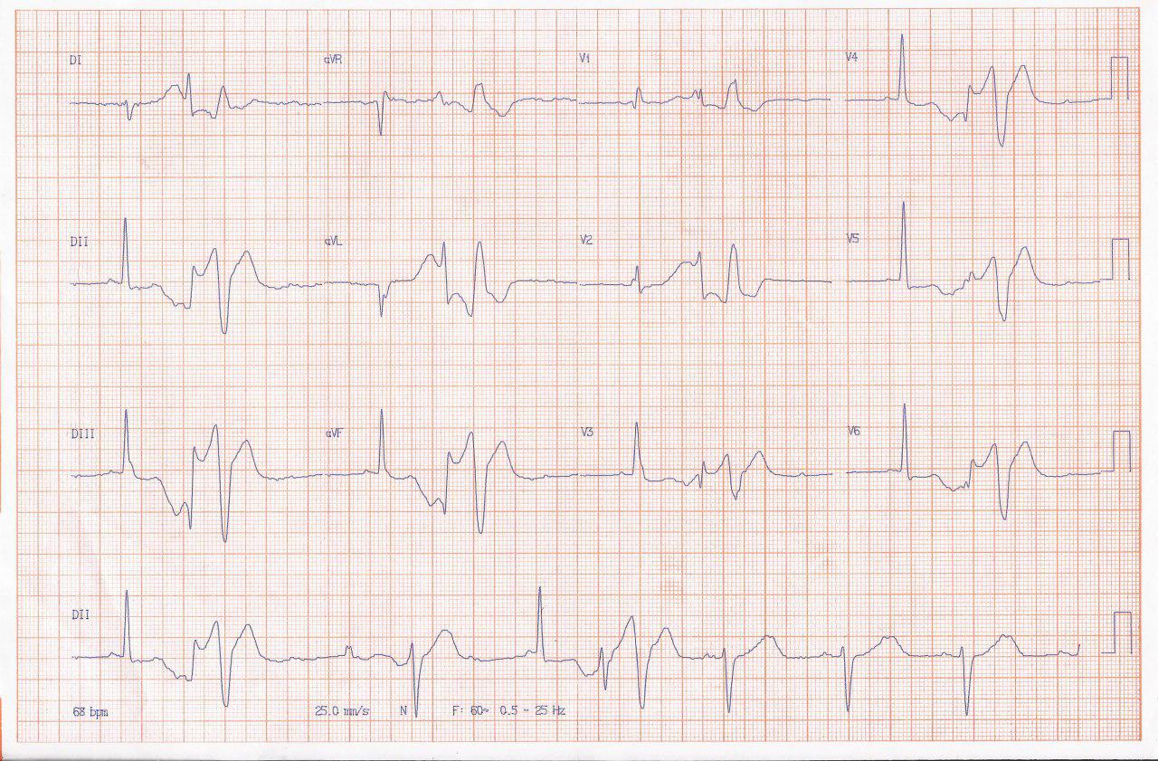 Mujer de 80 años que presenta episodios sincopales detectándose  bloqueo 2:1 alternando con disociación AV intermitente y CCG normal