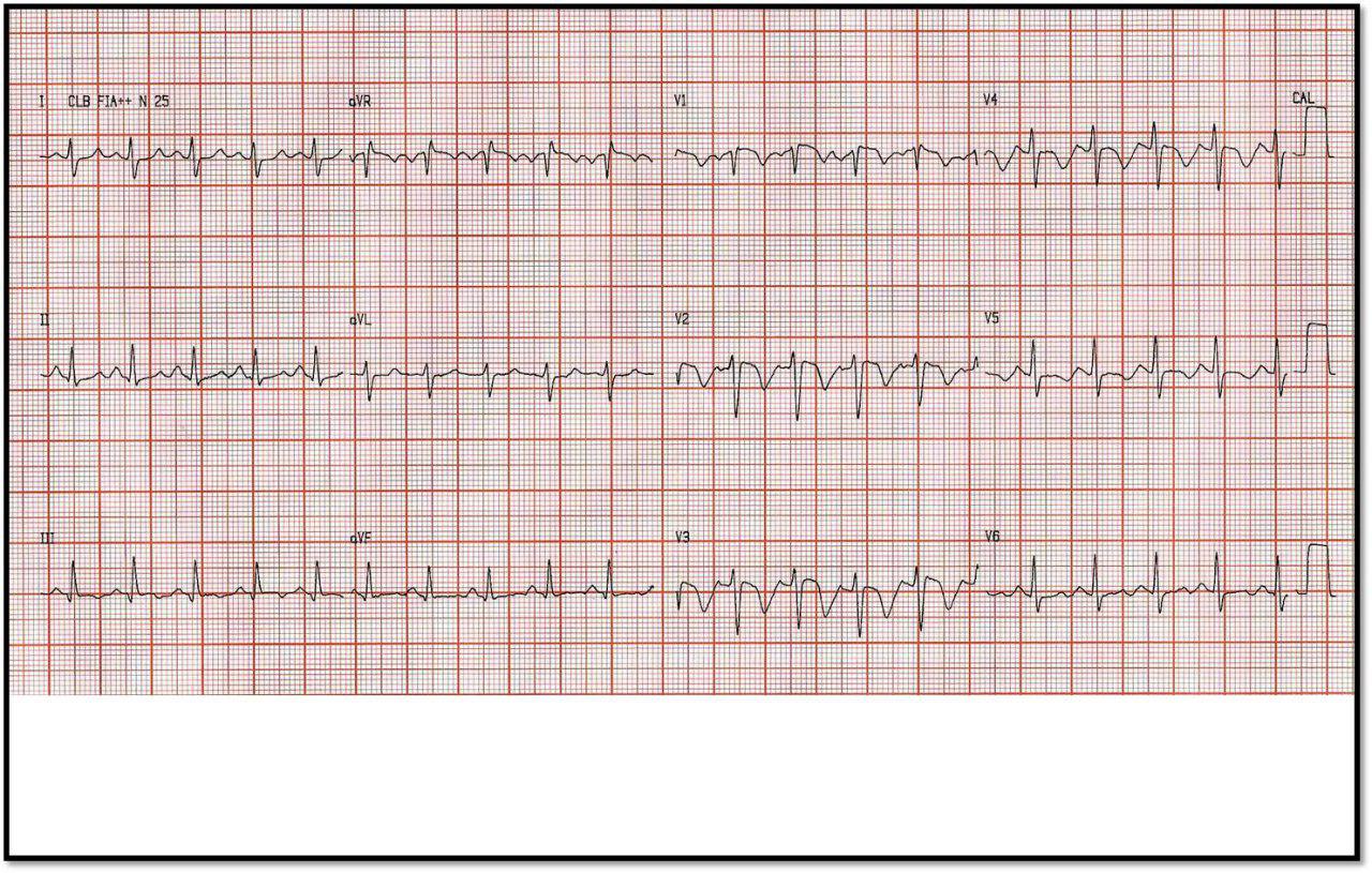Paciente obeso de 32 años con dolor precordial y disnea súbitos por presentar TEP bilateral con presencia de trombos