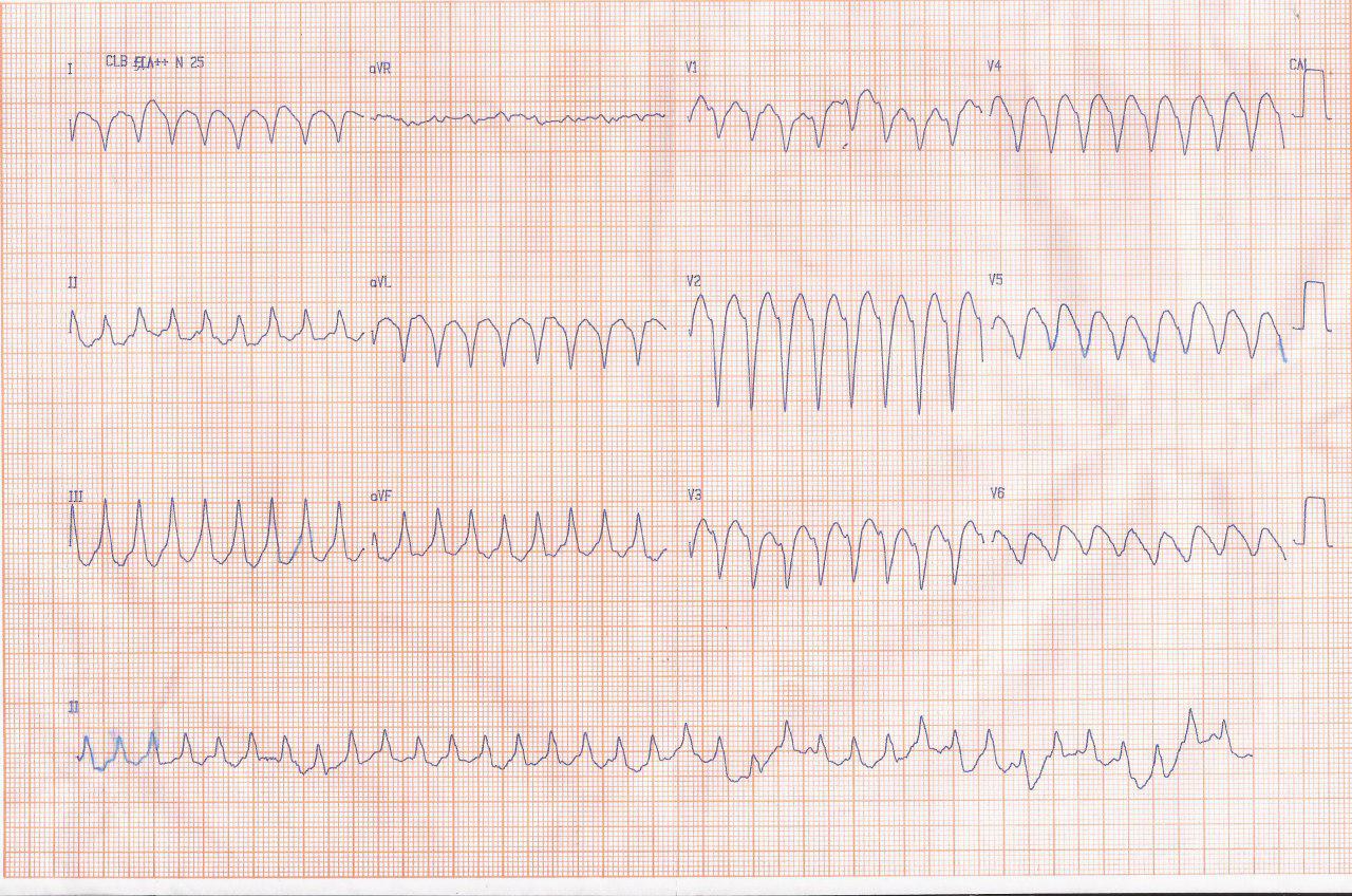 Hombre que hace 15 días presenta angor prolongado y sudoración sin procurar atención médica repitiendo el cuadro con visión borrosa constatándose TV y compromiso de la ADA