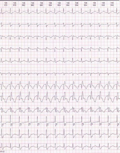 Mujer de 32 años con diagnóstico de anomalia de Ebstein y palpitaciones en paciente portadora de WPW debido a TRAVO