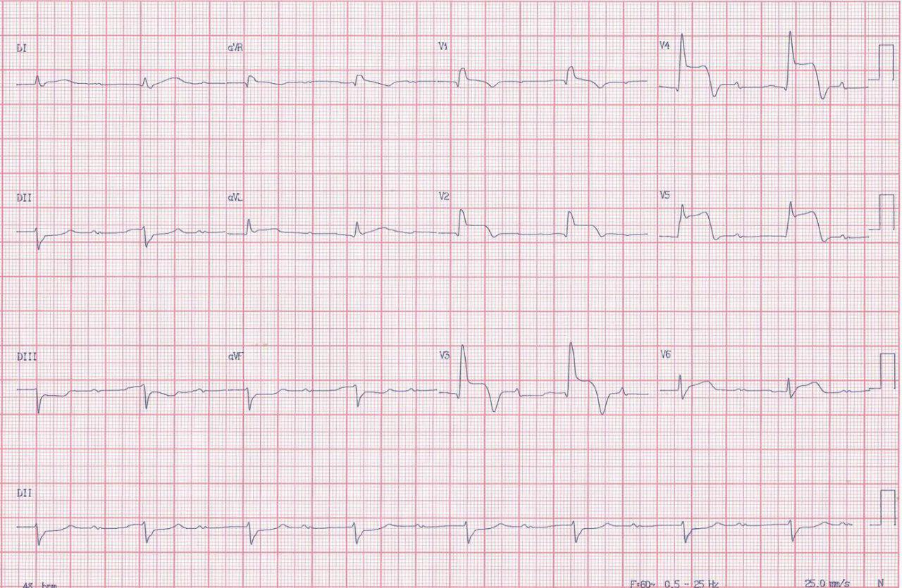 Hombre de 79 años con SCA a quién se tromboliza por carecerse de acceso a angioplastia que presenta en forma asociada BAVC y que muestra empeoramiento de conducción hisiana luego de inyección de atropina