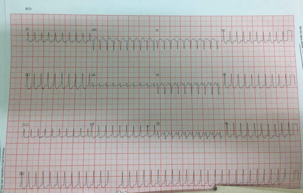 Mujer de 27 años con palpitaciones por presentar TRAVO que cede con una segunda dosis de adenosina por presencia de una vía anómala anterolateral izquierda