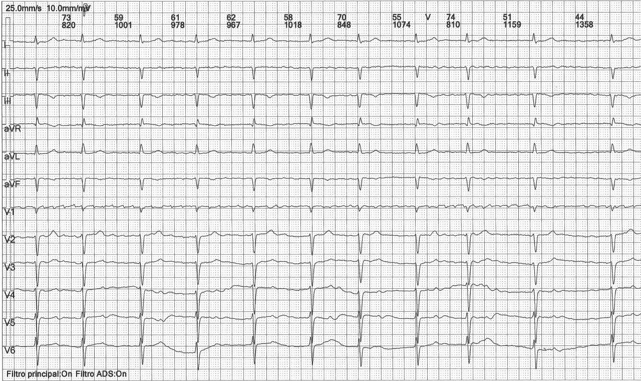 Mujer de 67 años con cuadro de ICC y FA crónica que presenta insuficiencia mitral y tricuspídeas severas y signo de Peñaloza Tranchesi en el ECG
