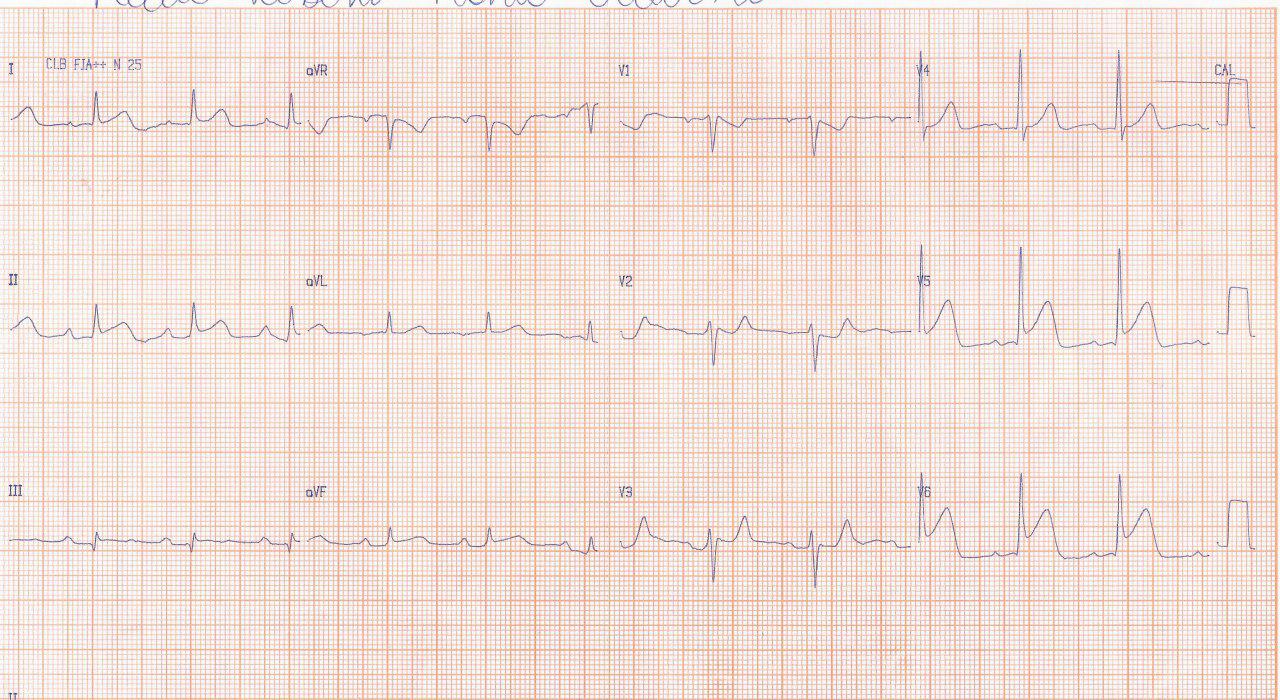 Dos casos de SCA: el primero por compromiso de la arteria Cx y el segundo, más grave por compromiso de la DA