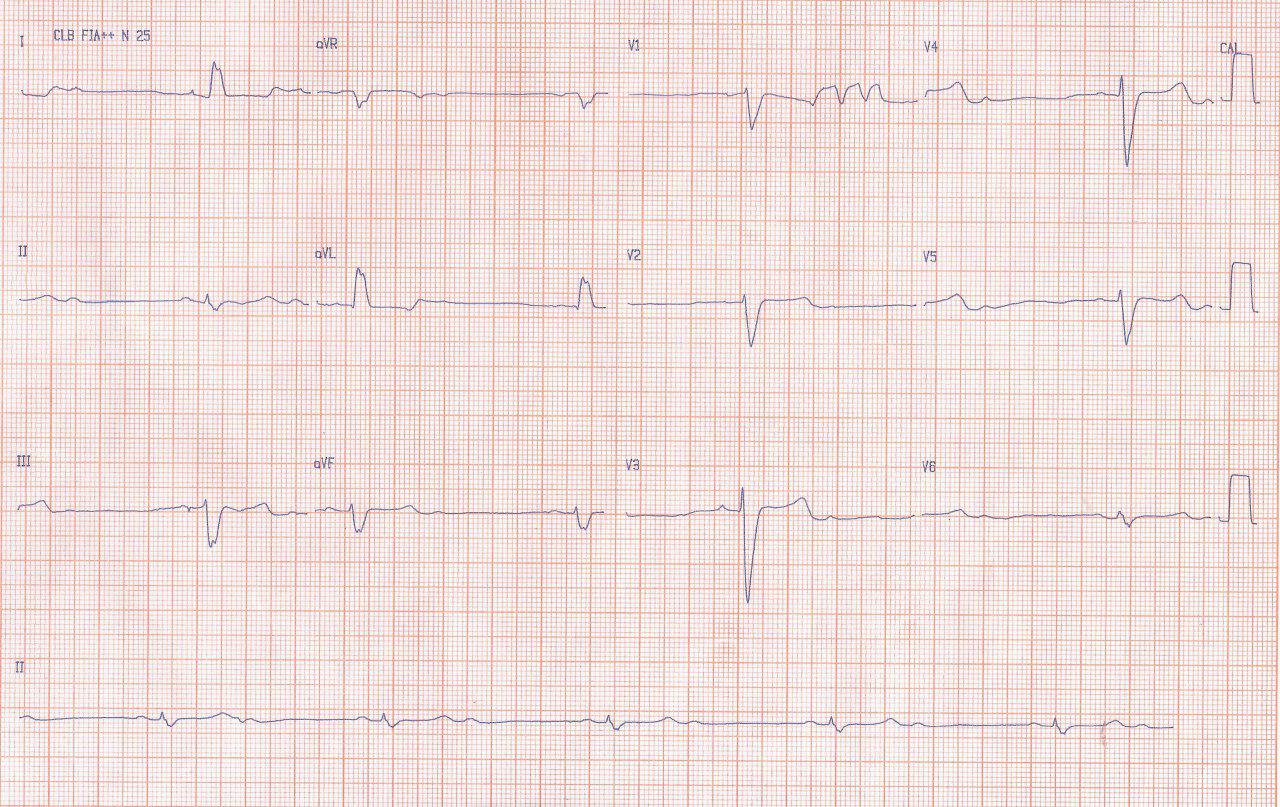 Hombre de 74 años portador de MCD que presenta episodios sincopales al que se implanta MP transitorio y luego TRC-D