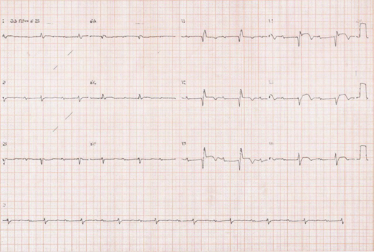 ECG de paciente de 79 años obtenido 5 días después de IAM que muestra sospecha de aneurisma de VI y BIA-A