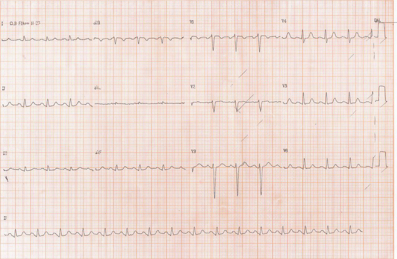 Mujer que presenta disnea de esfuerzo y paroxística nocturna con palpitaciones por presentar ritmo prefibrilatorio y episodios de FA en Holter con insuficiencia mitral por ruptura de cuerdas tendinosas