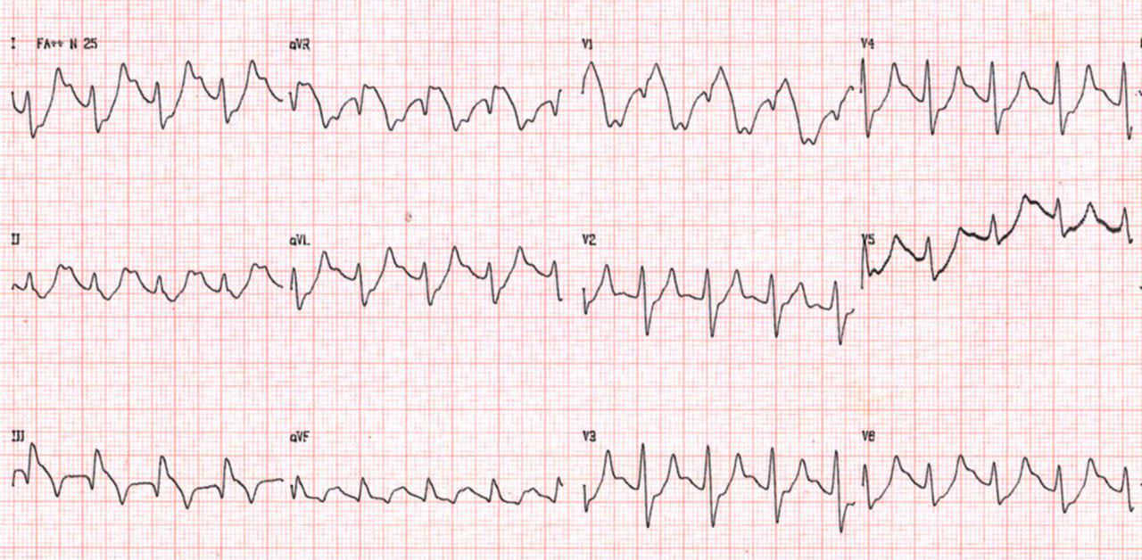 Paciente hipertenso y diabético con dolor precordial que presenta hipercalemia que al ser corregida, muestra mejora de los cambios electrocardiográficos