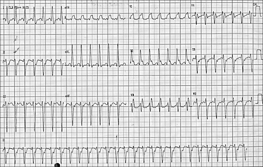 Paciente masculino de 38 años con palpitaciones por taquicardia regular sostenida cuyo origen SV o V fascicular es discutido