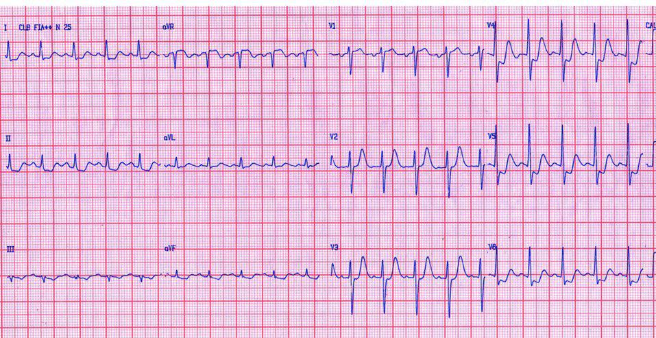 Mujer de 61 años portadora de anemia autoinmune que cursa con SCA por lesión severa de tres vasos