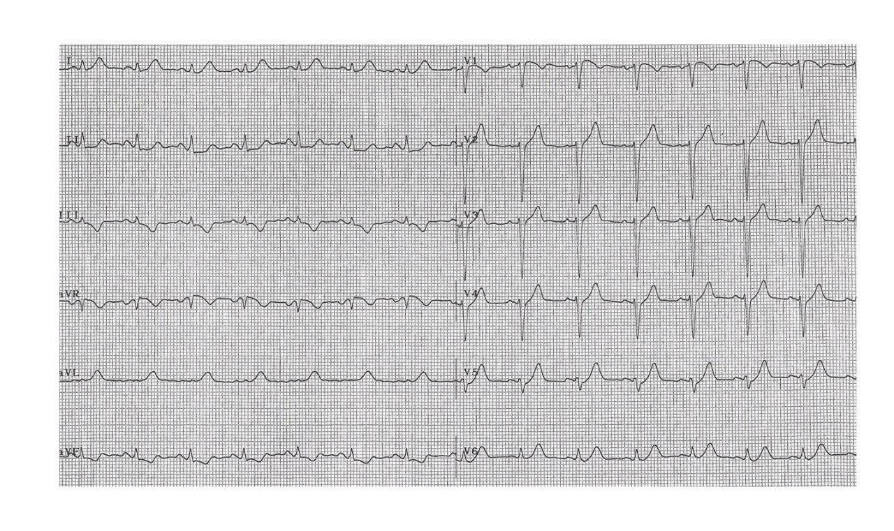 Paciente de 47 años con SCA por compromiso de DA que presenta perforación coronaria durante CCG y posterior corrección con stent