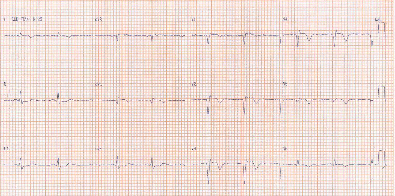 Paciente en insuficiencia cardíaca clase III que presenta tres signos electrocardiográficos sugerentes de aneurisma ventricular: fQRS, bajo voltaje en V5 V6 y elevación persistente del ST