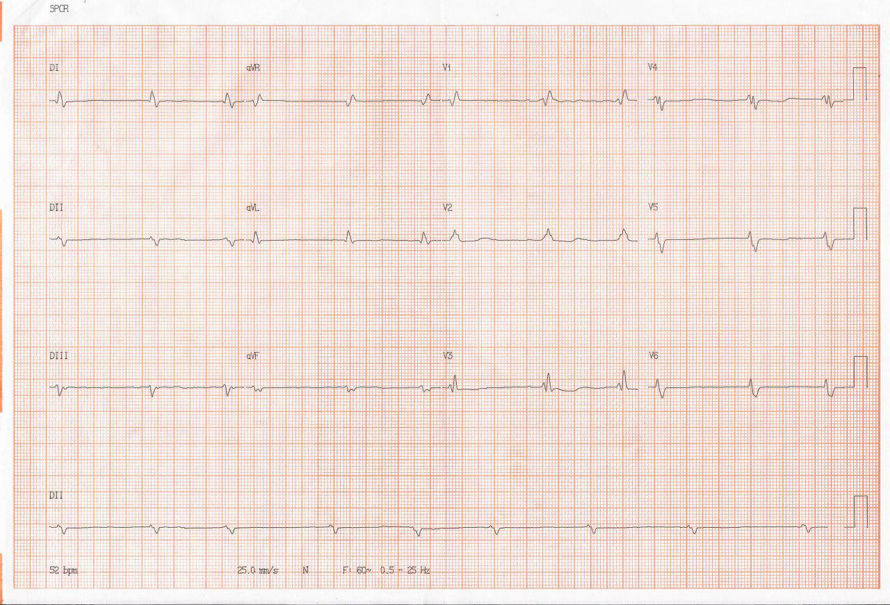 Paciente de 59 años portador de miocardiopatía chagásica que presenta paro cardíaco intrahospitalario durante consulta de rutina