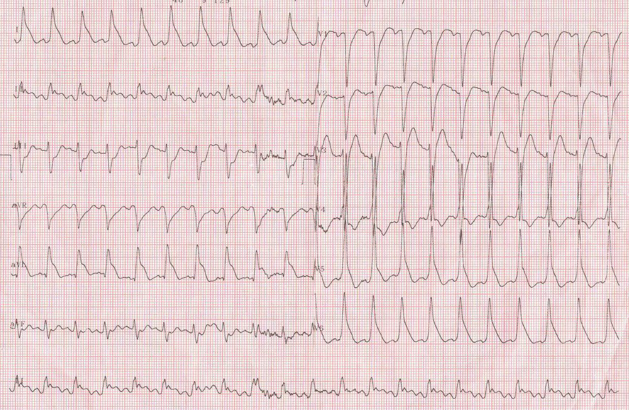 Paciente de 40 años portador de miocardiopatía dilatada probablemente alcohólica y CCG normal que ingresa con FV que logra revertirse mostrando el ECG postreversión ondas lambda