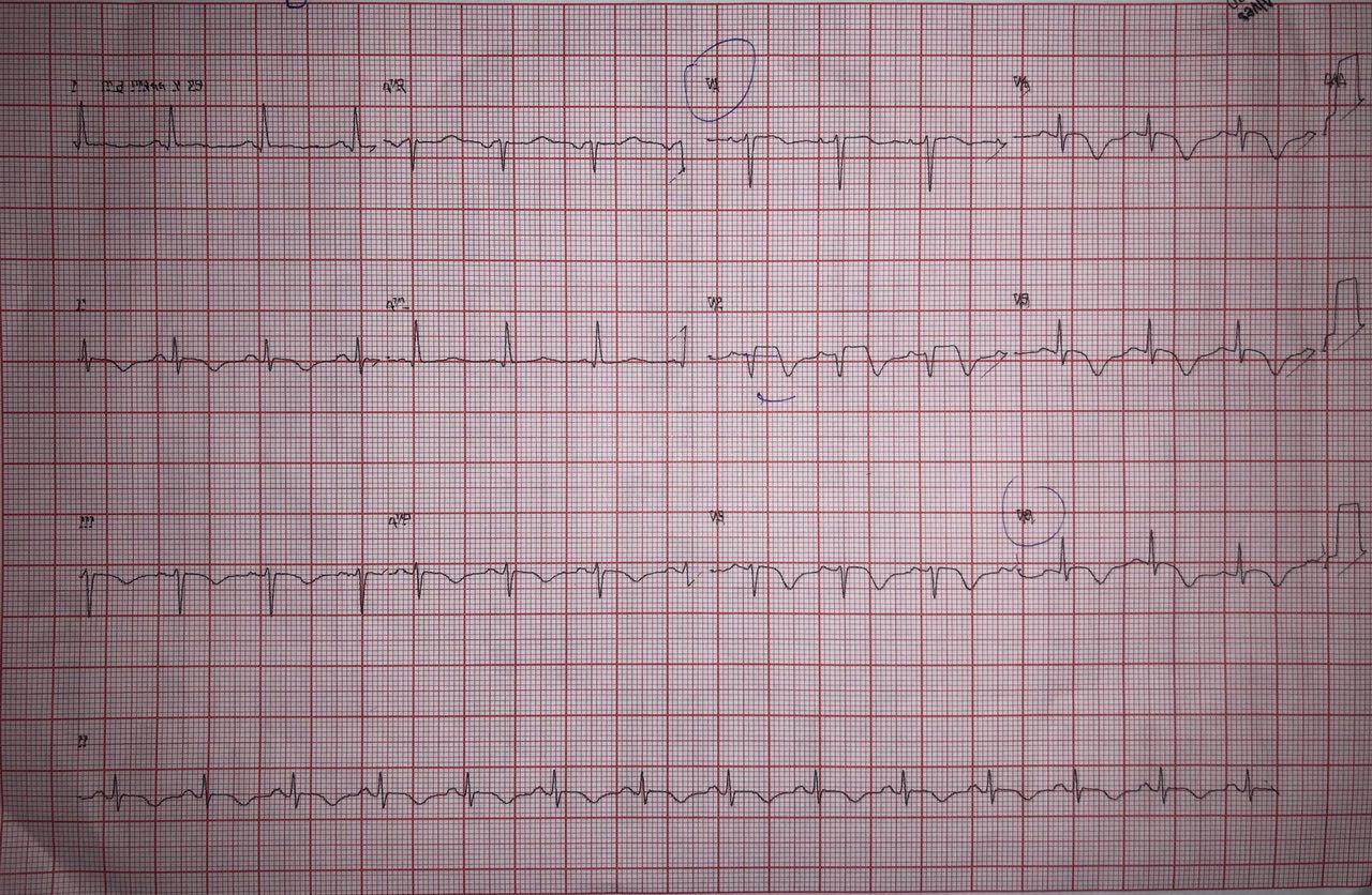 Mujer de 79 años con angor prolongado luego de stress emocional que cursa con leve elevación de troponina y tiene arterias coronarias normales en CCG constatándose síndrome de Tako Tsubo