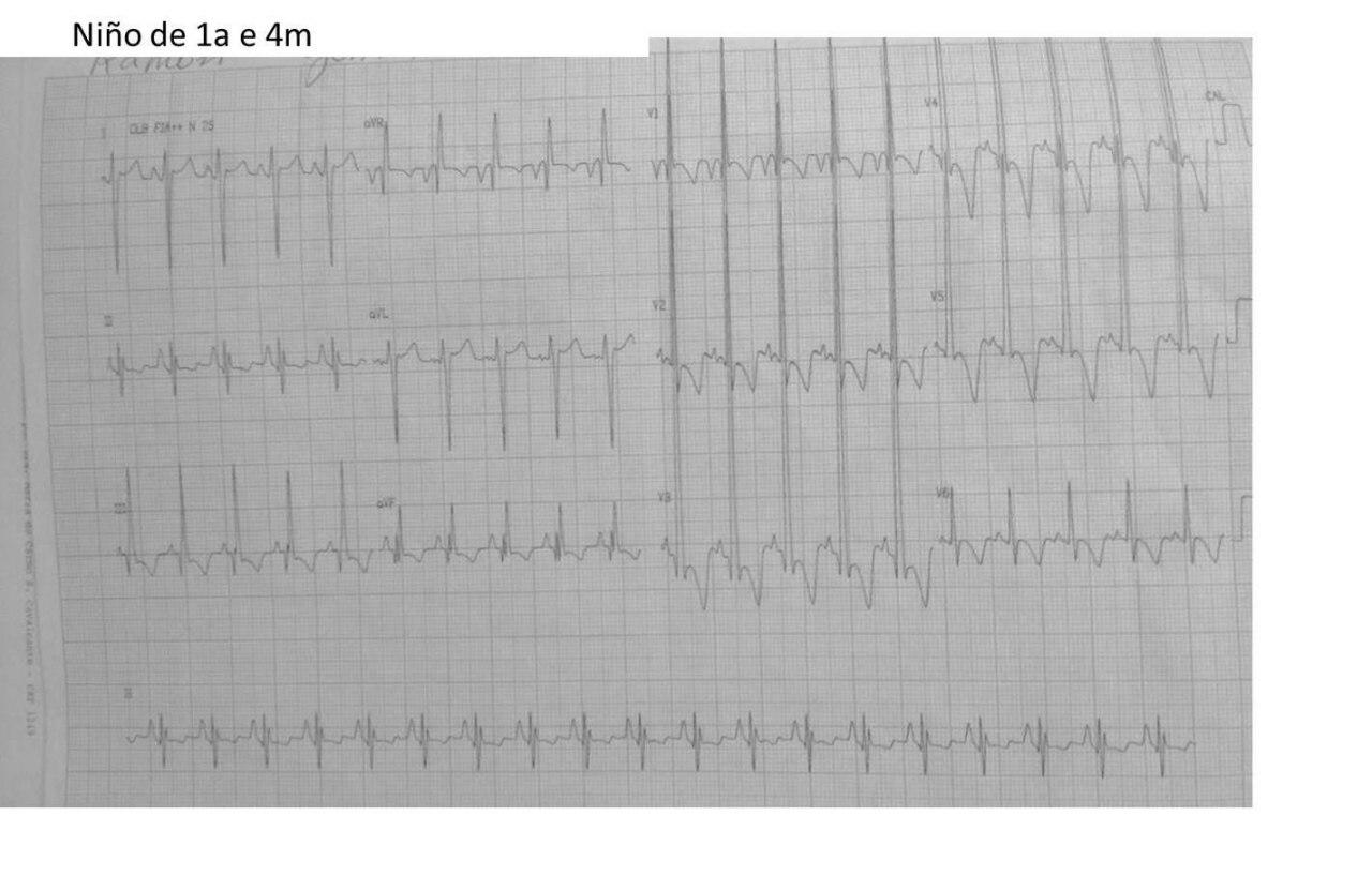 Niño de 1 año 4 meses con soplo sistólico y frémito en foco pulmonar por estenosis valvular pulmonar severa