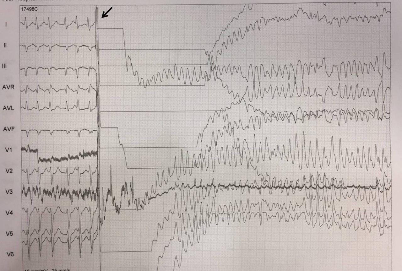 Choque eléctrico no sincronizado de FA que determina evolución a FV