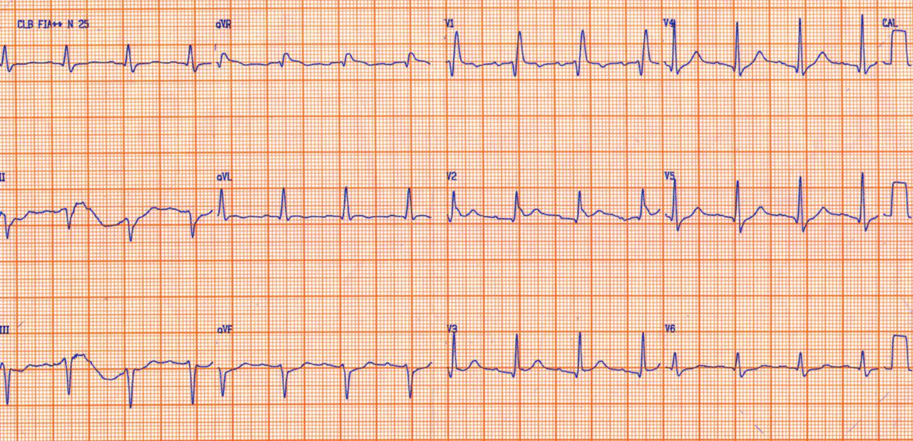 Paciente masculino de 71 años con FR que ingresa por angor inestable y que presenta SCA con BCRD + HbAI + PR largo constatándose lesión crónica de DA del 100%