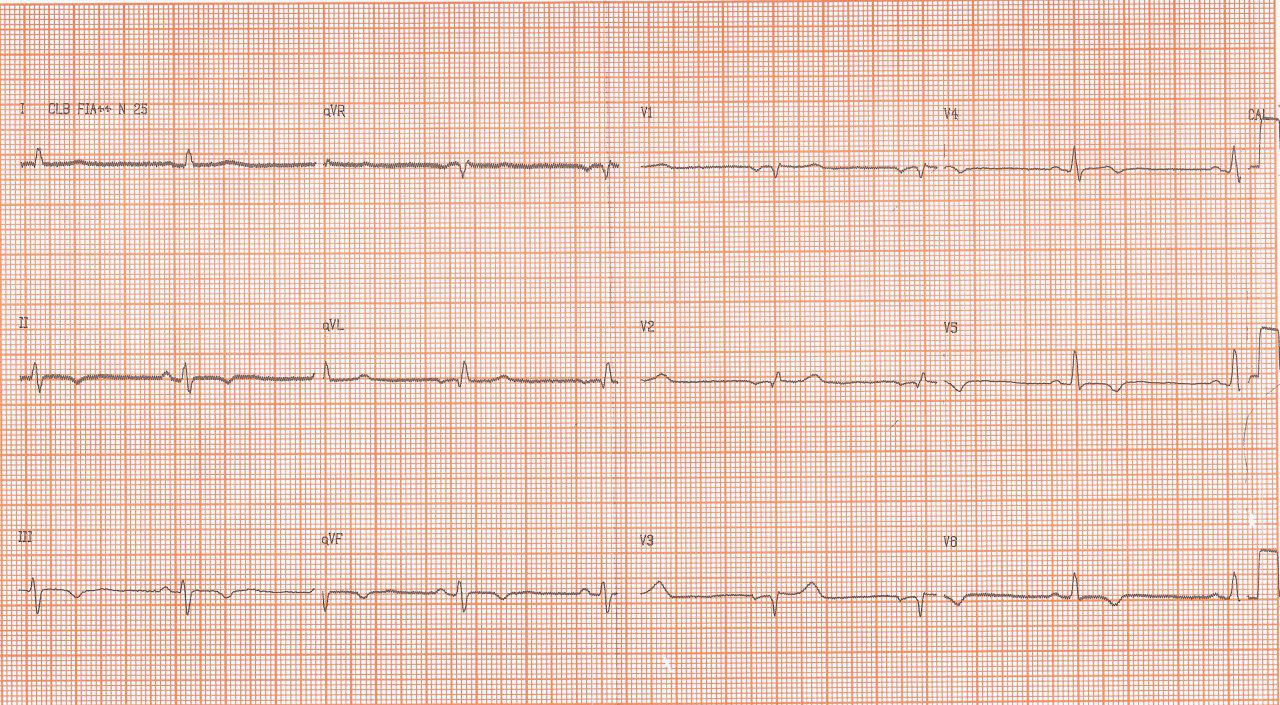 Evolución ECGráfica desde 2011 de mujer que ingresa por episodio sincopal con diagnóstico de miocardiopatía chagásica y CCG normal