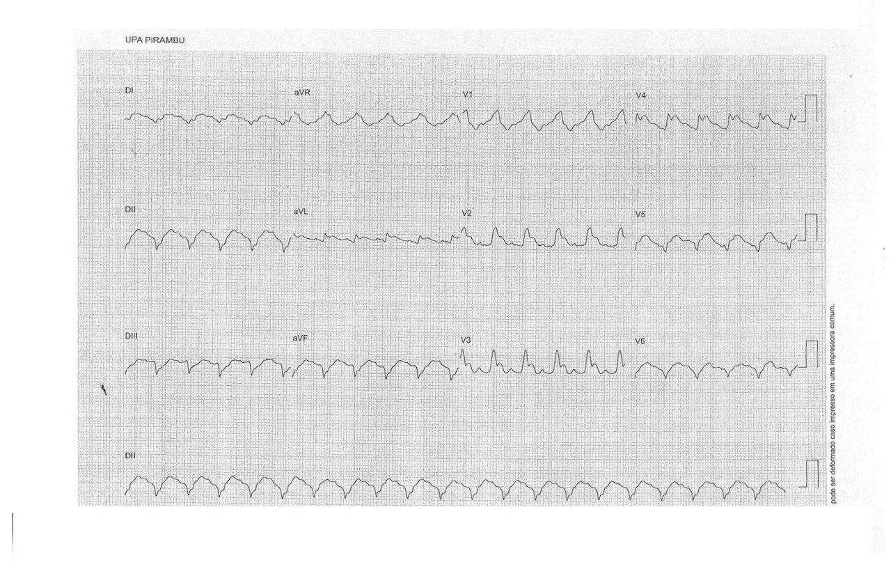 Paciente de 48 años con shock anafiláctico por picadura de abeja que desarrolla síndrome de Kounis y fallece