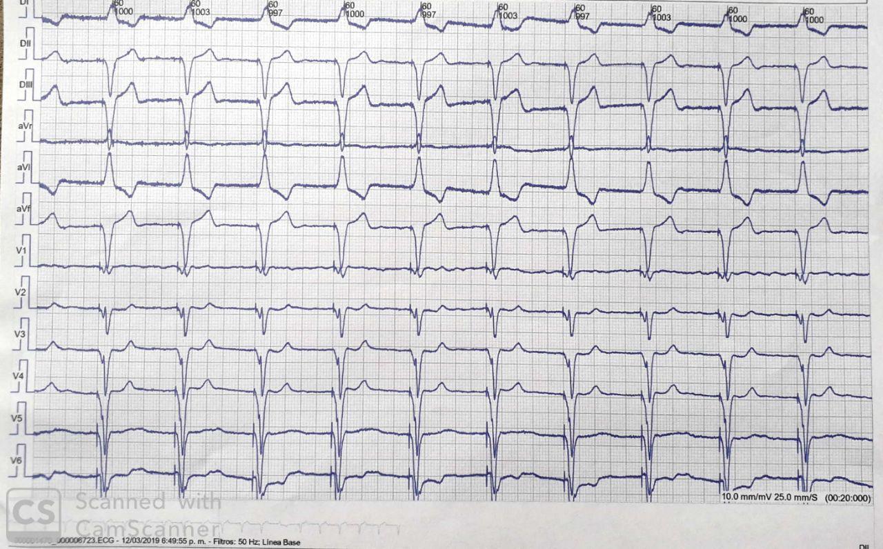 Femenina de 86 años con miocardiopatía dilatada portadora de MCP VVI que presenta captura 100 % alternando con latidos propios de FA permanente con imagen de BCRD y capturas del VVI y memoria miocárdica.