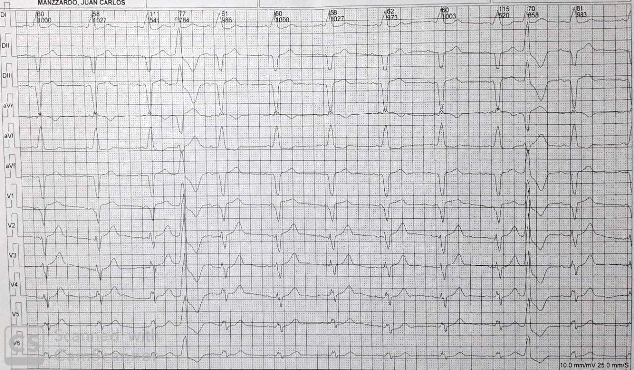 Paciente portador de MP DDD en cuyo ECG con filtro muscular NO se observan espigas que en cambio sí son visibles al eliminar los filtros