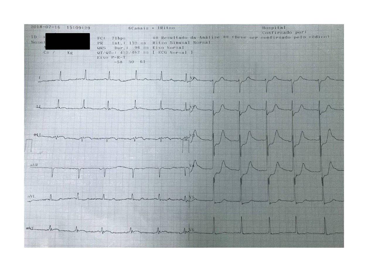 Anciano que cursa cuadro de IAM ínferolateral por lesión de Cx