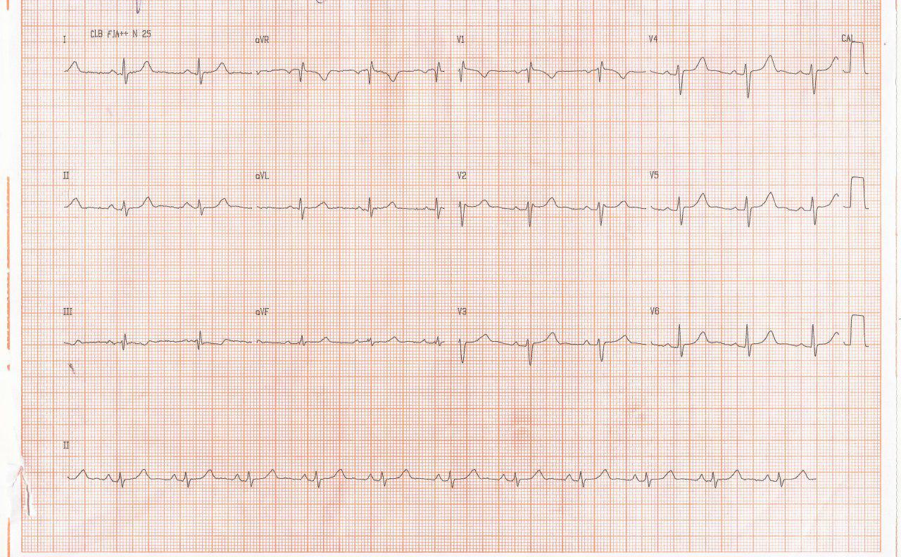 Mujer de 29 años con CIA OS que presenta en el ECG BIRD por hipertrofia de la crista y distensión de la rama derecha que desaparece luego de la cirugía correctiva