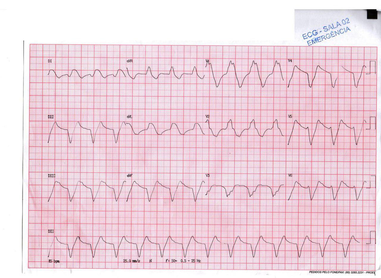 Paciente masculino de 70 años en tratamiento por ICC con mala evolución e hiperkalemia severa que se trata con gluconato de Ca
