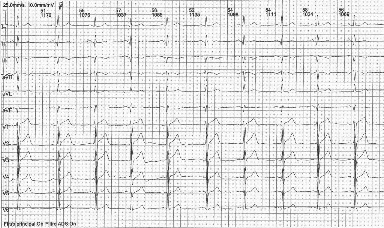 Hombre de 61 años, hipertenso y diabético con antecedentes de enfermedad coronaria, actualmente asintomático cuyo ECG muestra un BIA parcial
