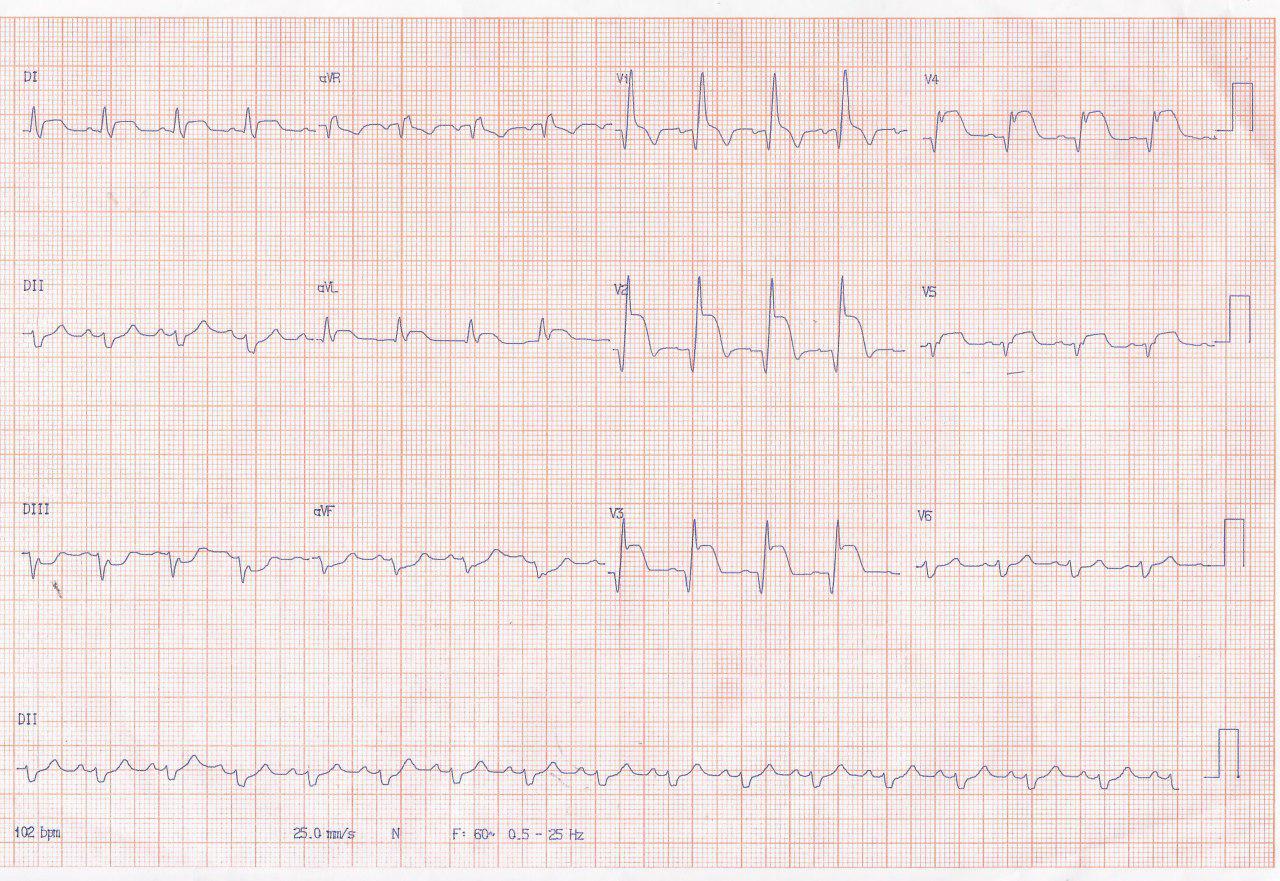 Paciente masculino de 66 años con IAM a quién se practica angioplastia primaria con implante de stent convencional con fracaso del procedimiento y posterior reimplante de stent farmacológico