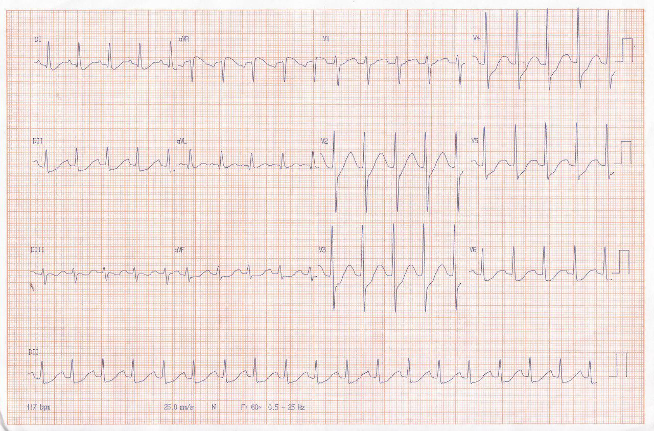 Hombre de 56 años con parálisis hipokalémica de 1,3 mEq/l por hipertiroidismo