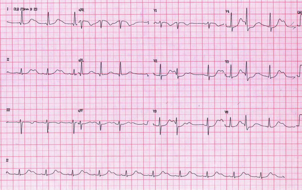 QT largo adquirido por severa hipopotasemia que se corrige